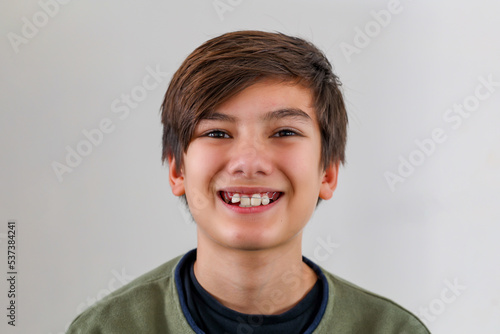 Children tooth care and hygiene. Portrait of a teenager boy with diastema overbite teeth missing gap wearing orthodontic appliance treatment. Dental braces with child concept.