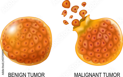 Cancer cells in Benign neoplasm and Malignant tumors.