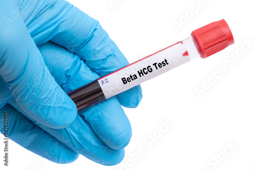 Beta HCG Test Medical check up test tube with biological sample