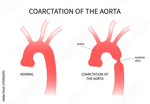 Heart coarctation of the aorta high blood pressure and Turner's disorder