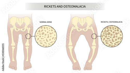 The rickets Blount's and Paget's disease of hip low density lack vitamin D with x-ray the medical anatomy