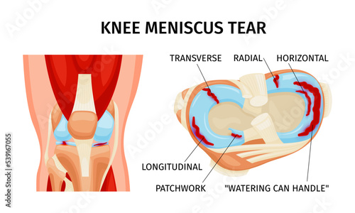 Knee Meniscus Tear Infographics