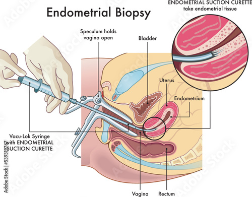 Medical illustration of the endometrial biopsy procedure with annotations.