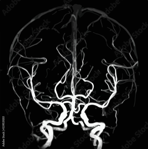 MR angiogram of cerebral arteries.