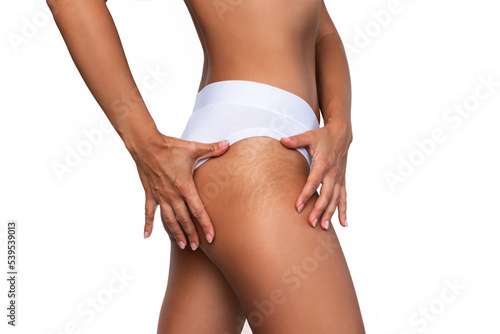 Cropped shot of young woman in white panties demonstrates stretch marks from a weight loss or weight gain on her thigh isolated on a white background. Body changes. Cosmetology, beauty concept
