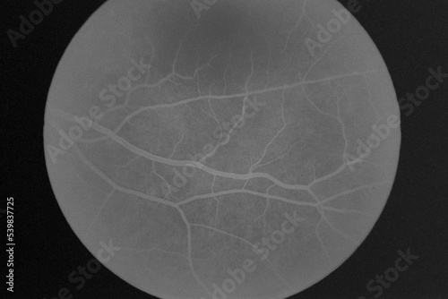 Fluorescein angiography of eye disease in the foreground 