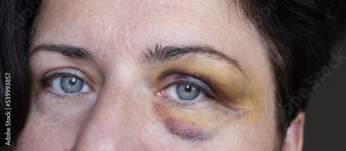 Close up of bruised woman eye. Face of a woman with a hematoma