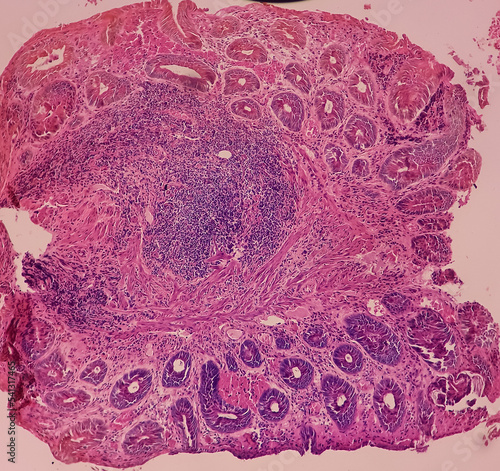 Anal canal ulcer biopsy: Chronic nonspecific proctitis, show anal mucosa, dense infiltration of lymphocytes, histiocytes and plasma cell in lamina propria with area of ulceration.