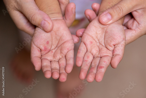 Parents hold the hands of a child with HFMD
