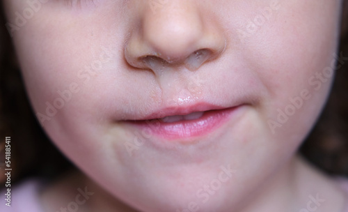 close-up of a girl's runny nose caused by a seasonal virus