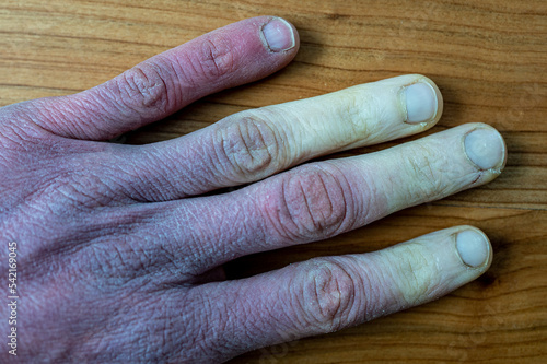 A frostbitten male hand with Raynaud's syndrome, Raynaud's phenomenon or Raynaud's disease.