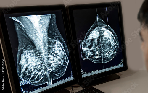 A doctor radiologist in a hospital mammography analysis room reading X-rays of a chest, breast and other parts of the body. The doctor makes notes by speaking into a dictaphone