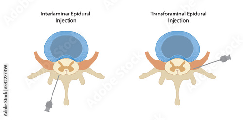 Epidural injection. Illustration of two differents techniques of epidural injection, interlaminar and transforominal