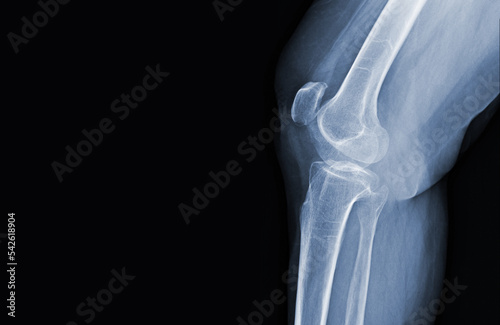 Film x-ray of human knee normal joints and ligaments Medical image concept.