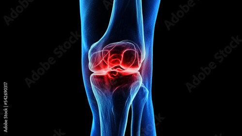 3d rendered medical illustration of a painful knee