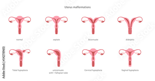 Human uterine malformations. Set of medical charts.