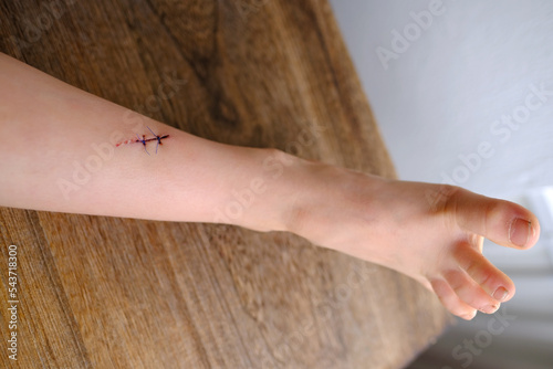 fresh wound on child's leg, non-absorbable sutures, wound care after skin procedure with sutures, trauma safety concept for children, treatment of surgical wounds, medical care, antiseptic treatment