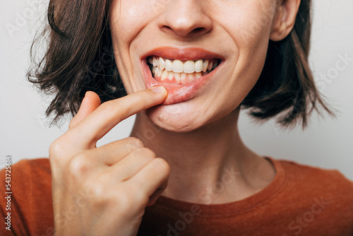 Close up shot of gum inflammation. Cropped shot of a young woman showing red bleeding gums isolated on a gray background. Dentistry, dental care