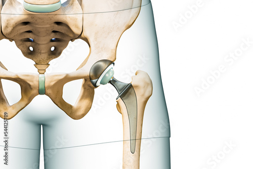 Hip prosthesis or implant isolated on white background with copy space and body contours. Hip joint or femoral head replacement 3D rendering illustration. Medicine, surgery, science concepts.