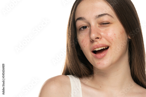 beautiful young winking women with problematic skin