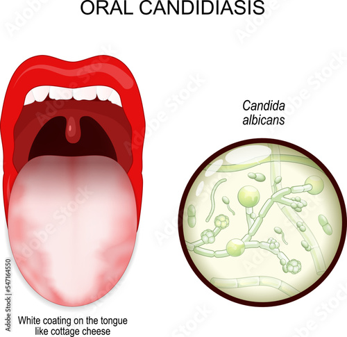 oral candidiasis. oral thrush yeast infection.