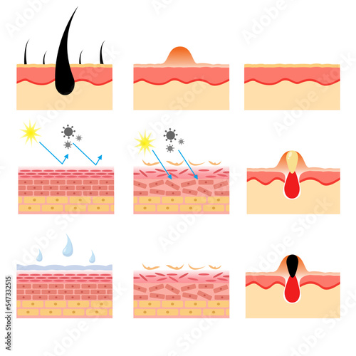 vector illustration of human skin structure anatomy. various skin conditions. epidermis and desmis. illustration for science and medical health.