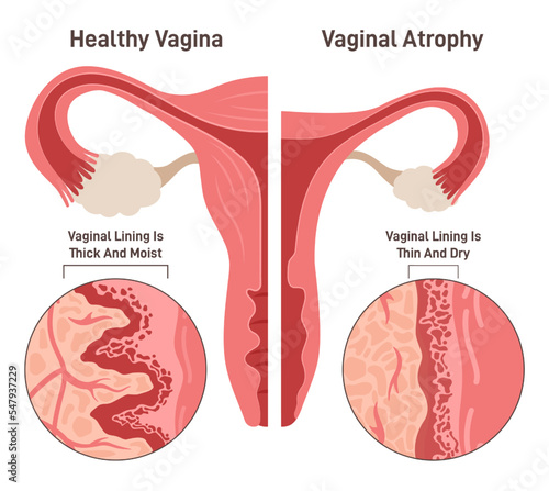 Vaginal atrophy. Thinning, drying and inflammation of the vaginal walls