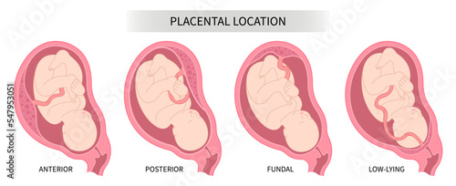 Pregnancy prenatal care and uterine wall growth restriction with baby Lateral placenta location back fetus Labour death intrauterine gender prediction