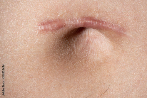 scar from umbilical hernia surgery