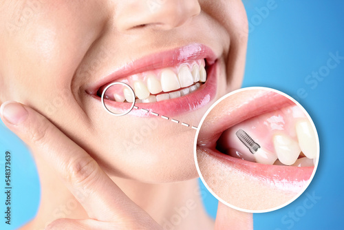 Woman with beautiful smile after dental implant installation procedure on blue background, closeup