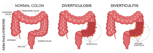 Diverticulitis and diverticulosis vector illustration. Medical structure and location. Diverticula infected or inflamed. Intestines. Bowel colon cancer, crohn's disease polyp hernia rectum