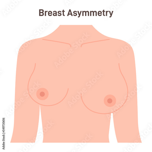 Asymmetric female breast. Different sizes of right and left boob