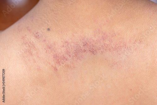 It is a dermatitis small warty bumps appear on the skin in child.