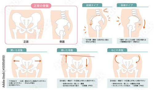 正常な骨盤の位置と歪んだ状態を表したイラスト