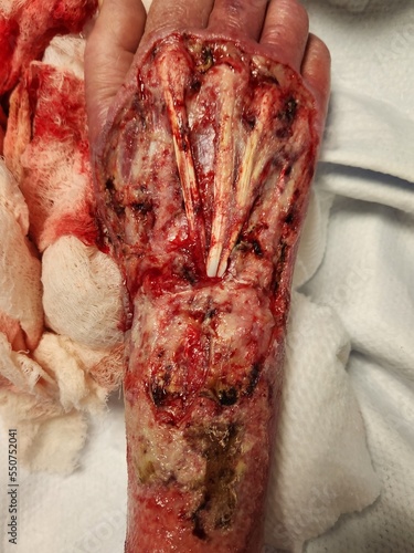 Necrotizing soft tissue infection right hand after debridement