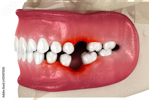 Teeth shift deformatiuon after losing molar tooth. 3D illustration of Popov Godon phenomenon