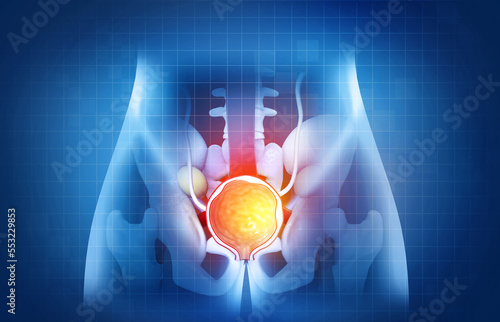 Prostate disease, Benign prostatic hyperplasia (BPH), Prostate cancer. 3d illustration