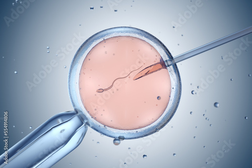 Artificial insemination or in vitro fertilization