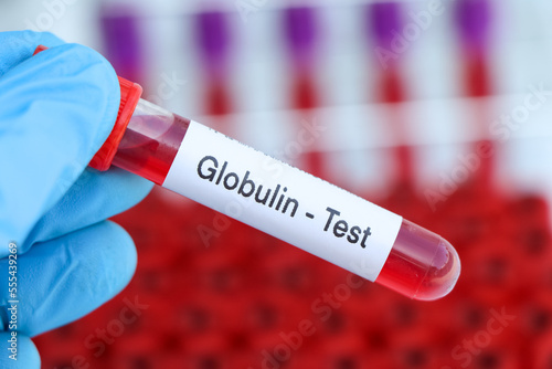 Globulin test to look for abnormalities from blood