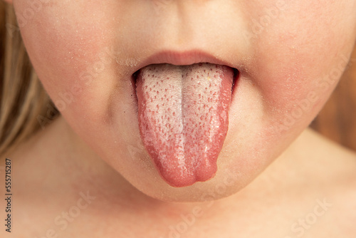 Strawberry tongue of a small child with scarlet fever caused by group A streptococcus