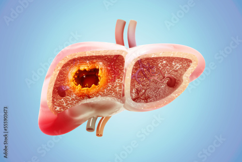 Liver cancer or liver tumor, Hepatocellular carcinoma (HCC), causes, symptoms, treatments, 3d illustration