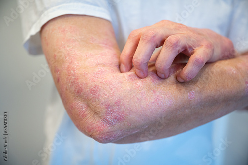 Itchy psoriasis on arm and hand