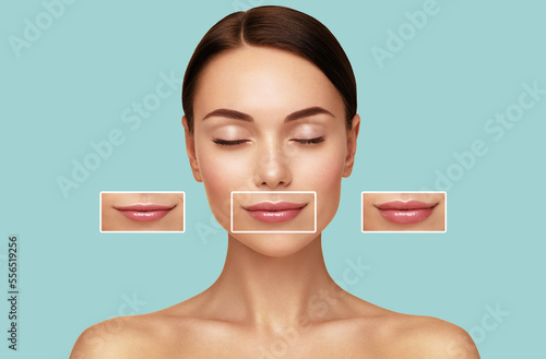 Hyaluronic acid injection. Women lips correction before and after comparison. Beauty lip treatment procedure.