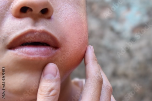 Swelling at the cheek of Asian young man. Inflammation of parotid gland called parotitis. Mumps.