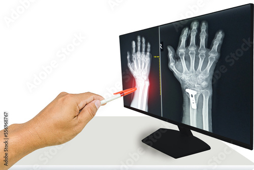 The doctor reported the x-ray results of the wrist of the fractured patient and performed bone fixation surgery.