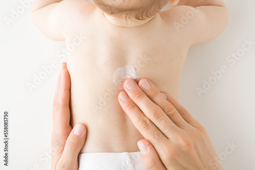 Mother fingers applying white medical ointment on infant bare back. Red rash on skin. Allergy from milk formula or mother milk. Care about baby body. Closeup. Top down view.