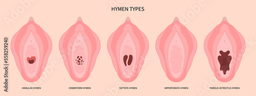 Anatomy of hymen before Hymenoplasty surgery for repair the procedure in medical