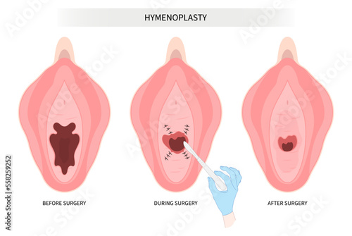 Hymenoplasty surgery for hymen repair the procedure in medical