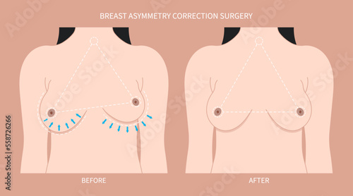 Woman breast sagging implant one bigger than pain examine density milk gland duct test lump Malignant cyst large mass size Lift Fat Transfer small shape