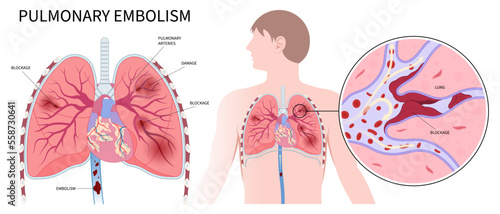 Post thrombotic lung edema blood clot chronic cough chest pain of stroke leg thrombus air spider vein high block vessel arteries acute limb ischemia swelling knee ulcer foot calf